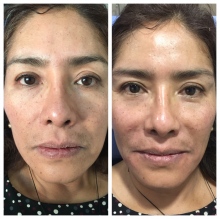 Maribel Rocio Armenta Osorio, Dermatólogo Puebla