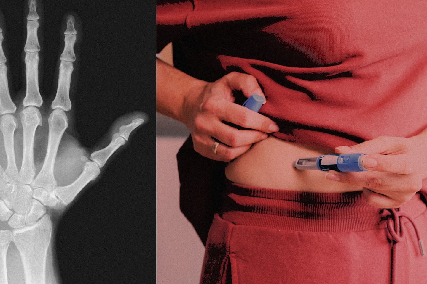 GLP-1 drugs like Ozempic can raise bone and tendon injury risk ...
