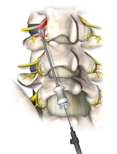 Medial Branch Radiofrequency Ablation Cahaba Pain And Spine Care