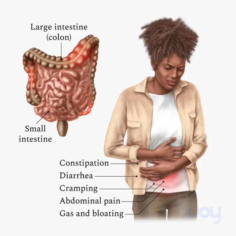 Illustration of a person with Irritable Bowel Syndrome (IBS) experiencing symptoms of diarrhea, constipation, abdominal pain