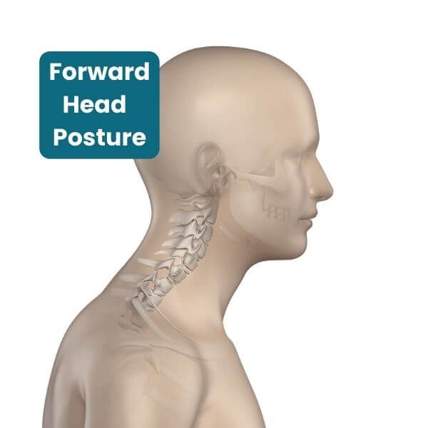 Forward Head Posture of the Cervical Spine for Yoga Anatomy School