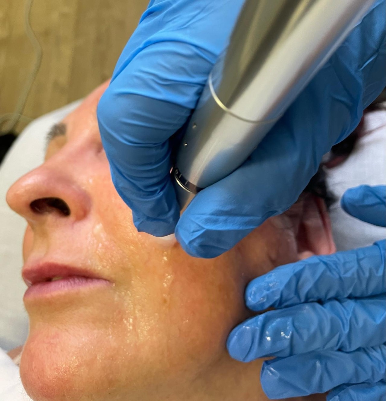 Skin needling treatment