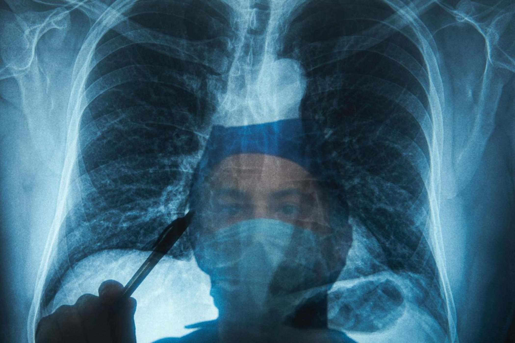 NHS Warns People Not to Ignore Common Lung Cancer Symptoms