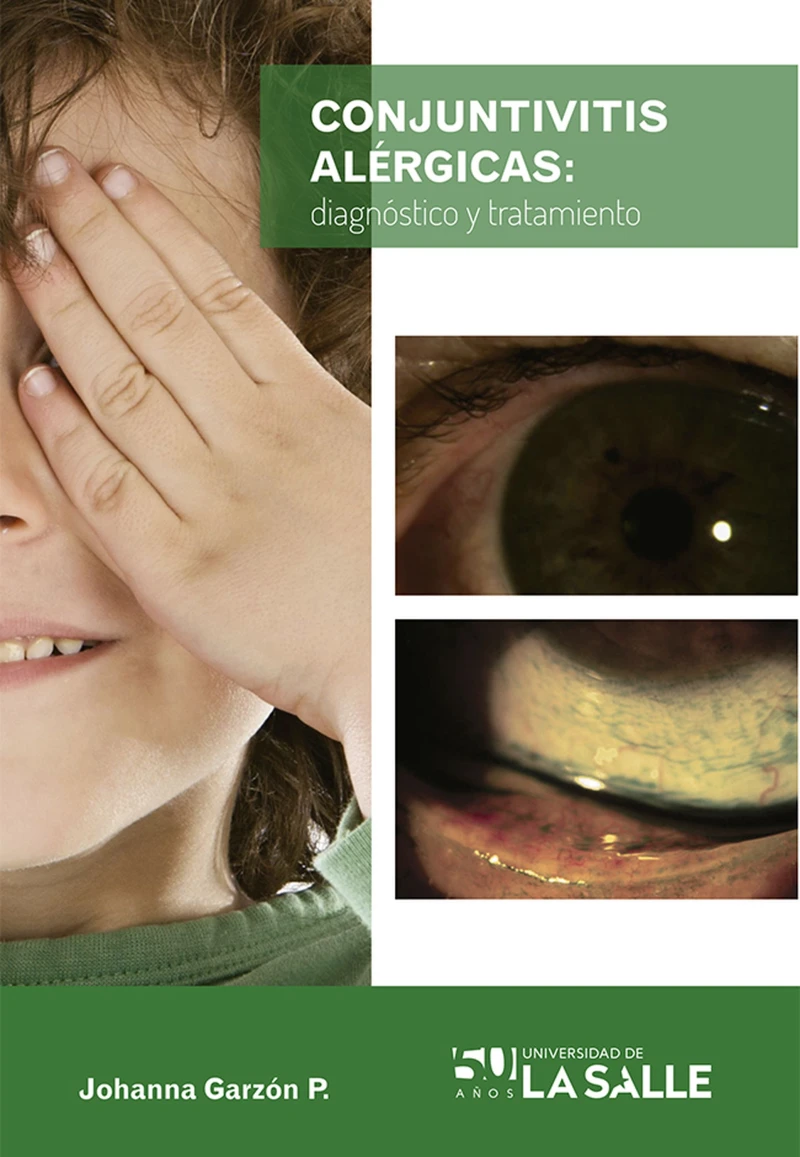 Portada: Conjuntivitis alérgicas