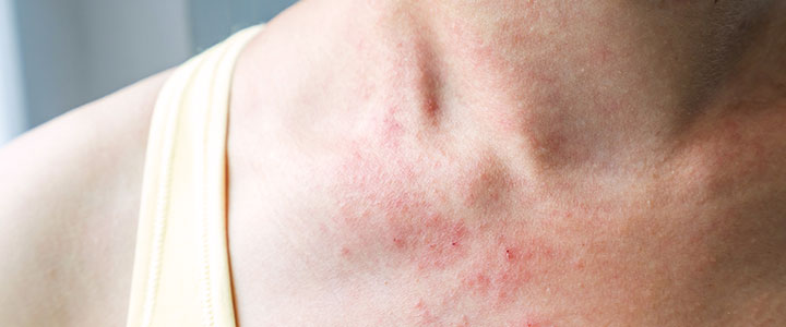 Pele sensível ou reativa: cuidados para toda esteticista | Bioage