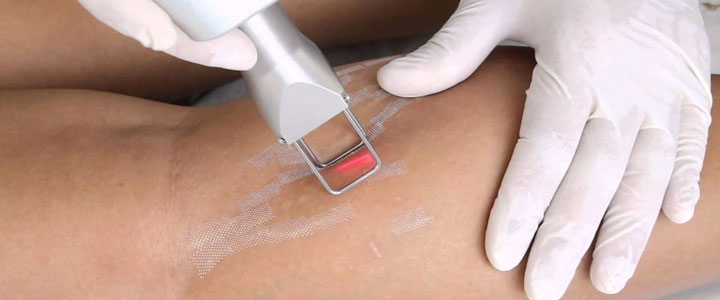 Tratamentos para estrias: como tratar cada tipo com eficiência? | Bioage