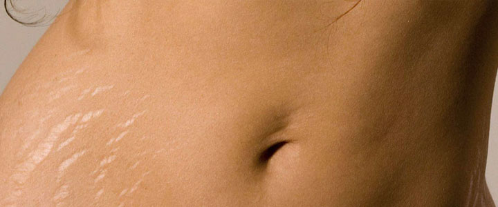 Tratamentos para estrias: como tratar cada tipo com eficiência? | Bioage