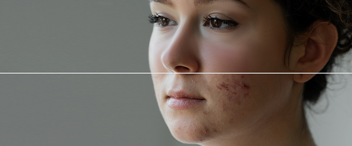 Tratamentos para poros dilatados: redução e prevenção | Bioage