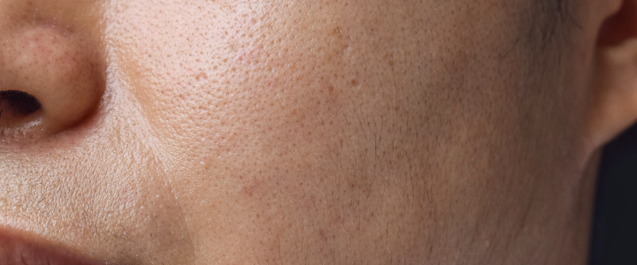 Pele oleosa: como identificar, cuidar e tratar | Bioage