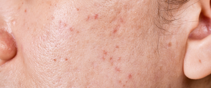 Pele oleosa: como identificar, cuidar e tratar | Bioage