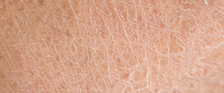 Ácido salicílico: o que é, como funciona e como aplicar | Bioage