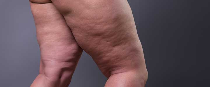 Celulite ou lipedema: entenda como tratar suas pacientes | Bioage
