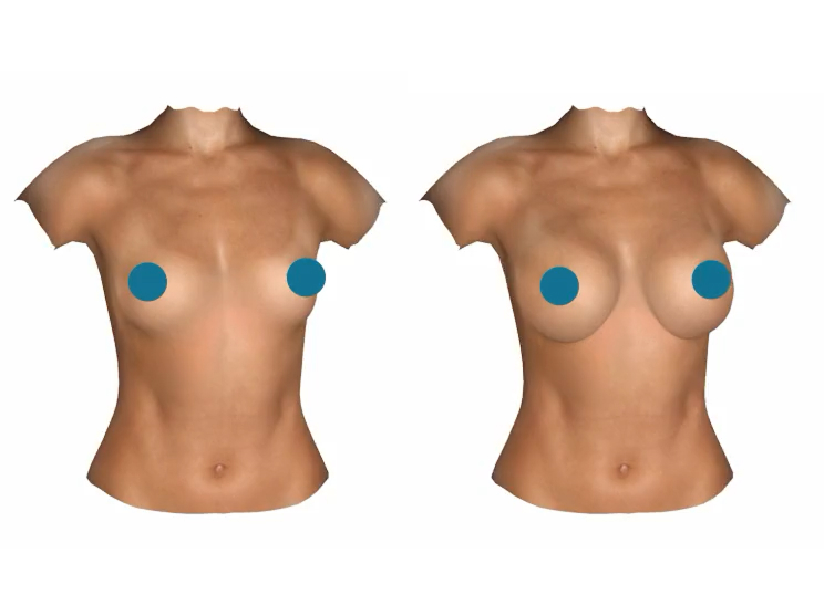 semaglutide and breast pain Ozempic Breast Denver