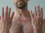 Imagen: OMS cambia el nombre de la viruela del mono a 'mpox' Imagen: OMS cambia el nombre de la viruela del mono a 'mpox'