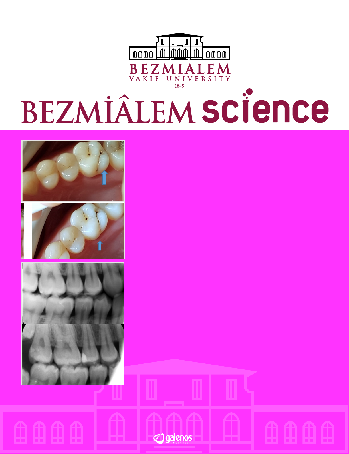 Clinical Evaluation of Class II Restorations Made with Bulk-fill Restorative Materials