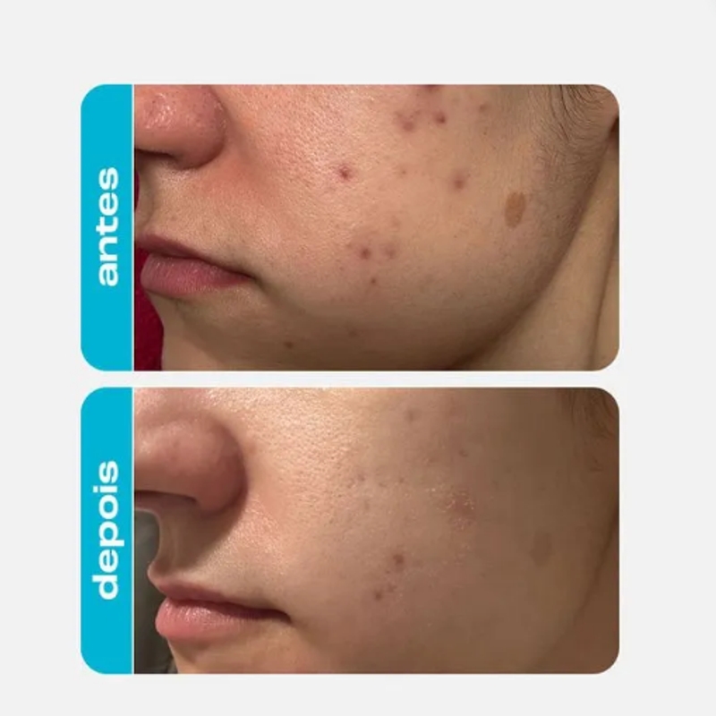 Esfoliante Químico - Ácido Glicólico - foto 3