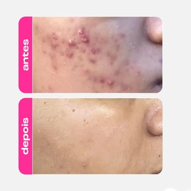 Gel Clareador Antiacne - Ácido Mandélico - foto 3