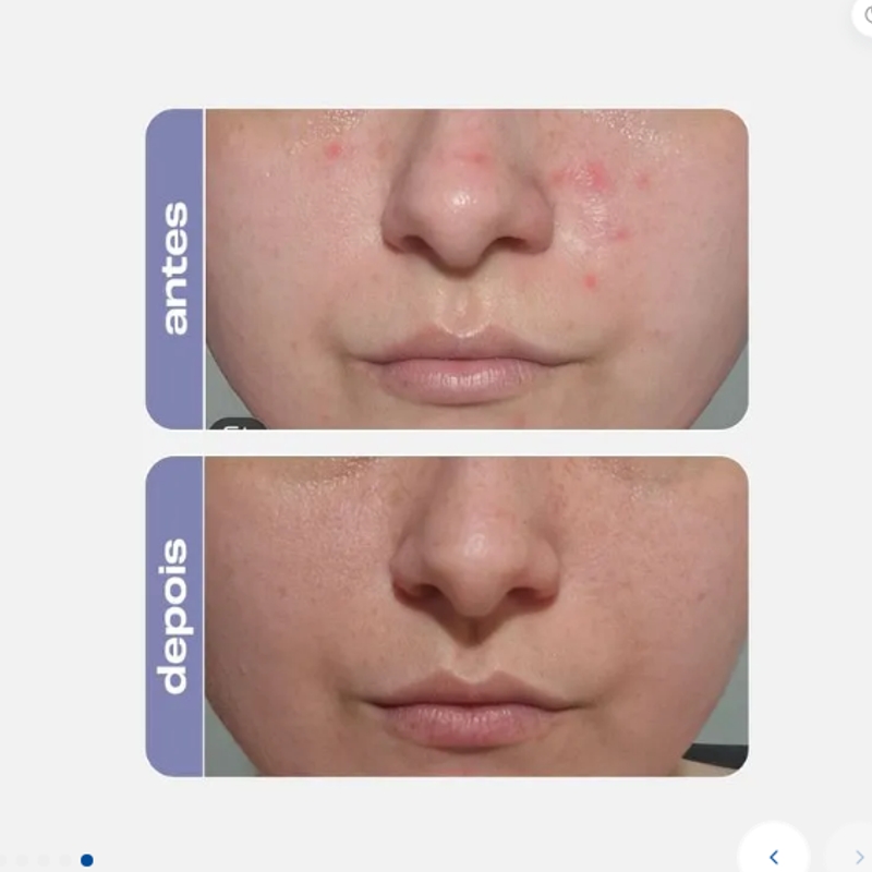 Sérum Antiacne Adapalenato - foto 4
