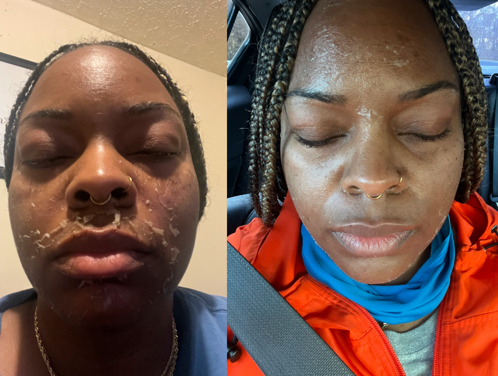 Chemical Peel
