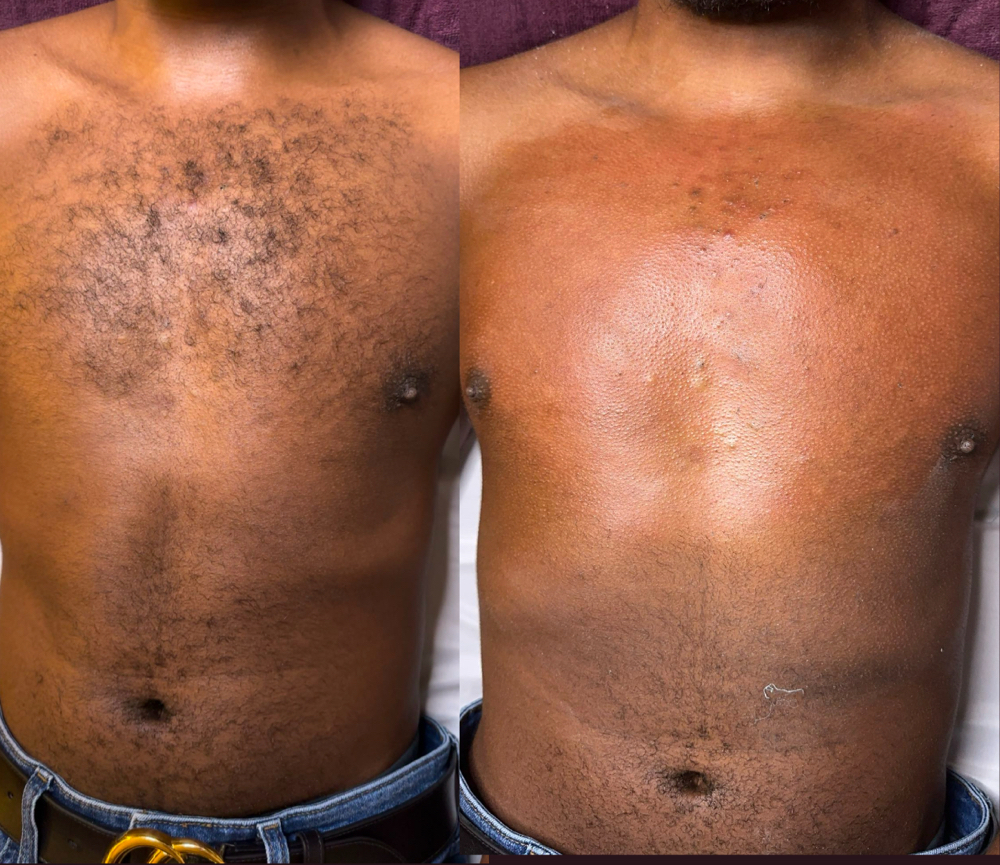 Chest Wax