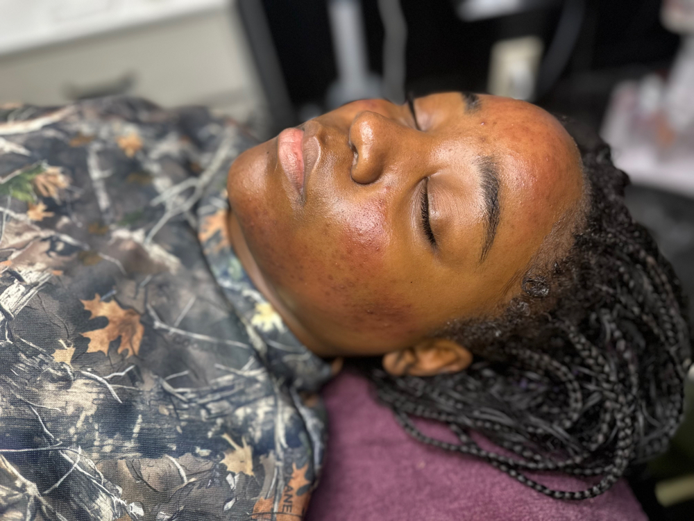 Microneedling