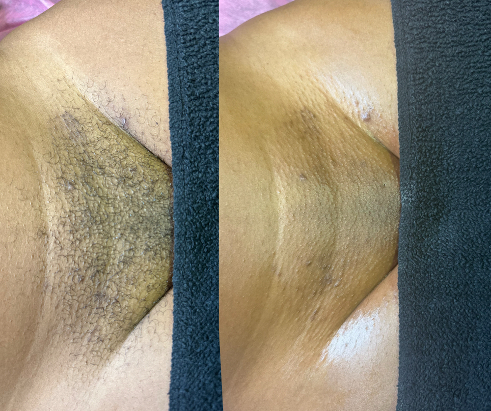 Brazilian Wax