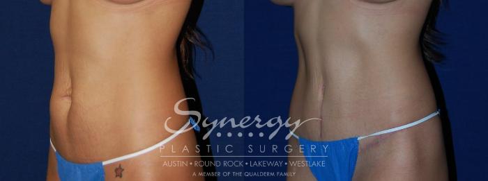 Before & After Abdominoplasty (Tummy Tuck) Case 102 View #1 View in Austin, TX