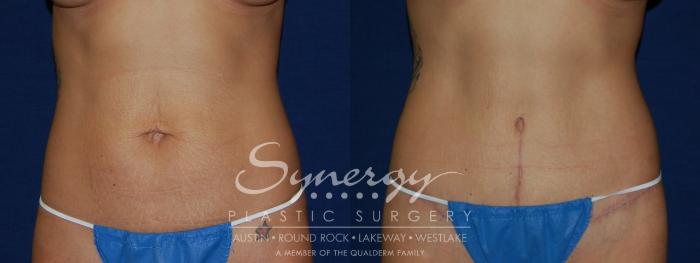 Before & After Abdominoplasty (Tummy Tuck) Case 102 View #2 View in Austin, TX