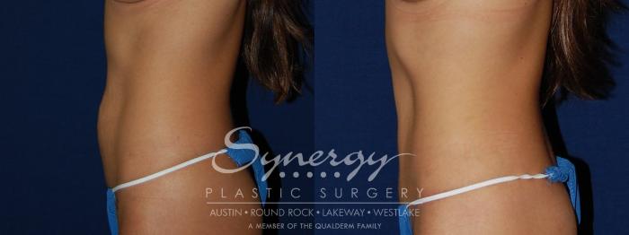 Before & After Abdominoplasty (Tummy Tuck) Case 102 View #3 View in Austin, TX