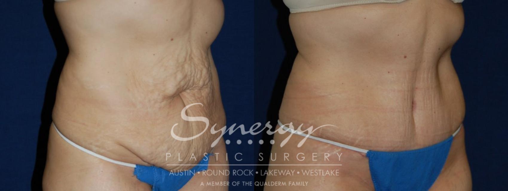 Before & After Abdominoplasty (Tummy Tuck) Case 103 View #1 View in Austin, TX