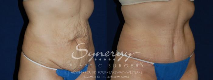 Before & After Abdominoplasty (Tummy Tuck) Case 103 View #1 View in Austin, TX