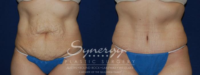 Before & After Abdominoplasty (Tummy Tuck) Case 103 View #4 View in Austin, TX