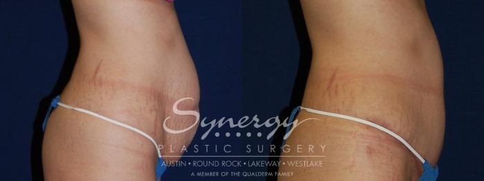 Before & After Abdominoplasty (Tummy Tuck) Case 105 View #2 View in Austin, TX