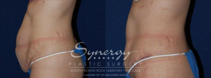 Before & After Abdominoplasty (Tummy Tuck) Case 105 View #3 View in Austin, TX
