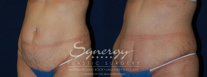 Before & After Abdominoplasty (Tummy Tuck) Case 105 View #4 View in Austin, TX