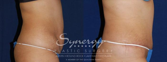 Before & After Abdominoplasty (Tummy Tuck) Case 106 View #4 View in Austin, TX