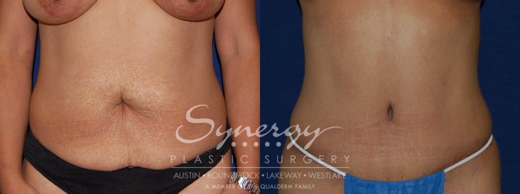 Before & After  Case 112 View #1 View in Austin, TX