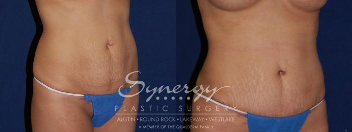 Before & After Abdominoplasty (Tummy Tuck) Case 115 View #2 View in Austin, TX