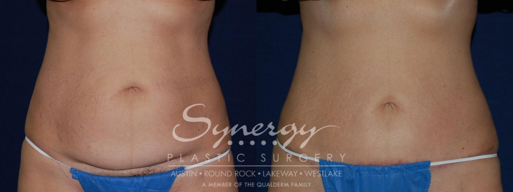 Before & After Abdominoplasty (Tummy Tuck) Case 138 View #1 View in Austin, TX