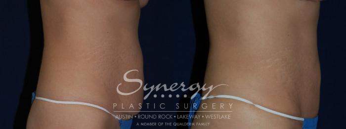 Before & After Abdominoplasty (Tummy Tuck) Case 138 View #4 View in Austin, TX