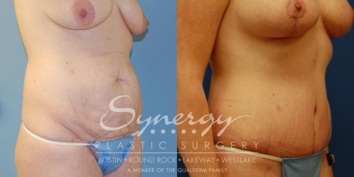 Before & After Abdominoplasty (Tummy Tuck) Case 14 View #2 View in Austin, TX