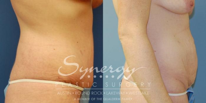 Before & After Abdominoplasty (Tummy Tuck) Case 14 View #3 View in Austin, TX