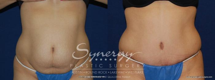 Before & After Abdominoplasty (Tummy Tuck) Case 148 View #4 View in Austin, TX