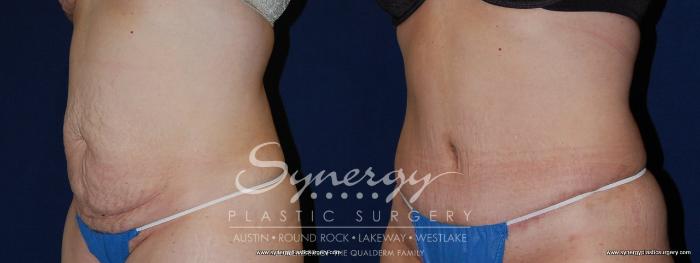 Before & After Abdominoplasty (Tummy Tuck) Case 149 View #1 View in Austin, TX