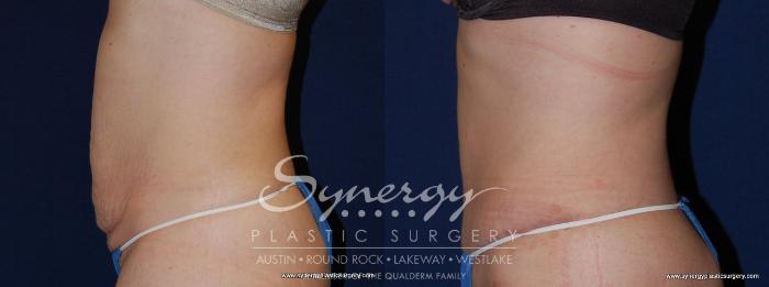 Before & After Abdominoplasty (Tummy Tuck) Case 149 View #3 View in Austin, TX