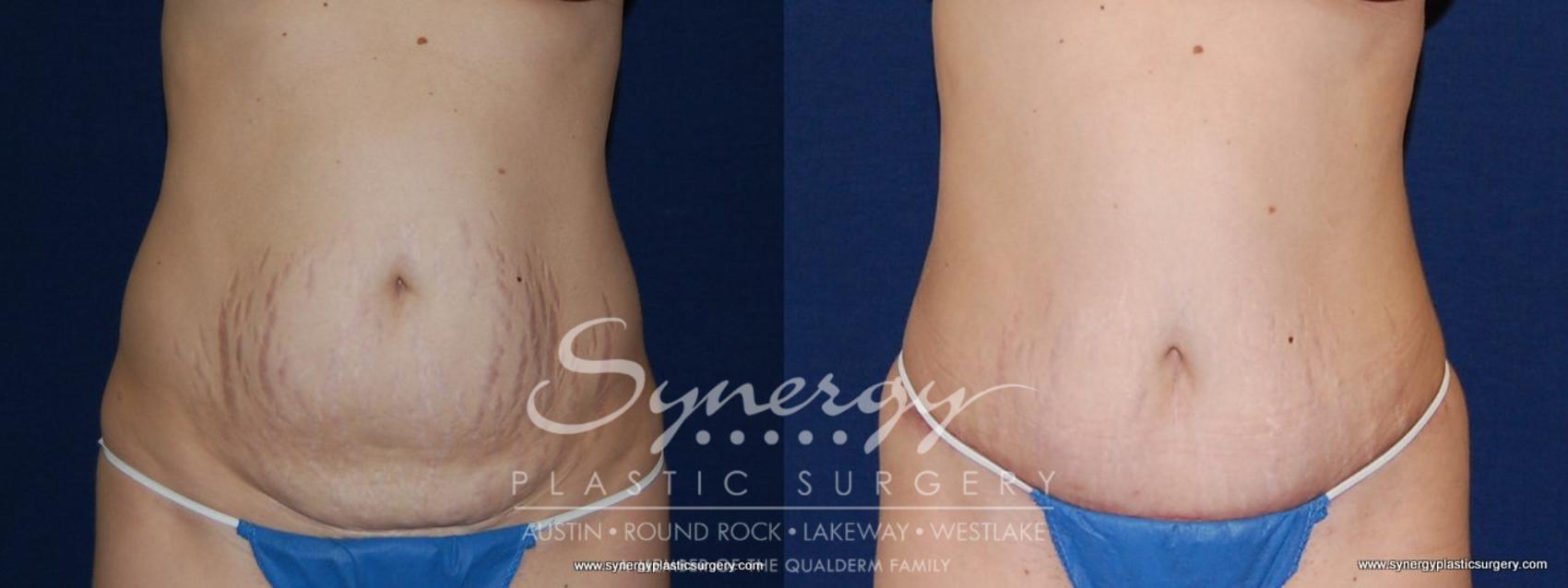 Before & After Abdominoplasty (Tummy Tuck) Case 152 View #1 View in Austin, TX