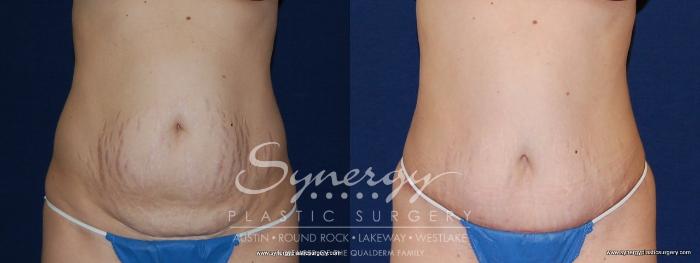 Before & After Abdominoplasty (Tummy Tuck) Case 152 View #1 View in Austin, TX