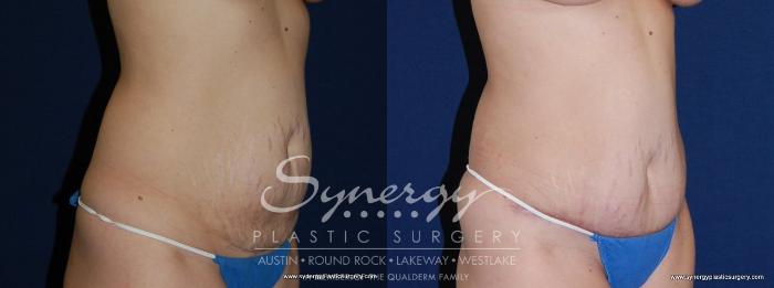 Before & After Abdominoplasty (Tummy Tuck) Case 152 View #3 View in Austin, TX