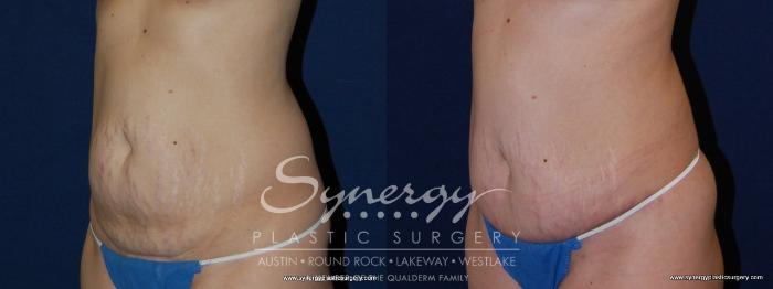 Before & After Abdominoplasty (Tummy Tuck) Case 152 View #4 View in Austin, TX