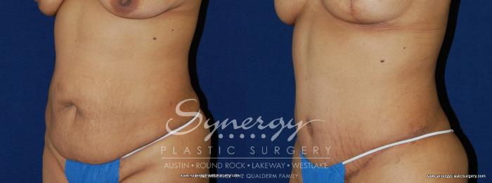 Before & After Abdominoplasty (Tummy Tuck) Case 156 View #2 View in Austin, TX